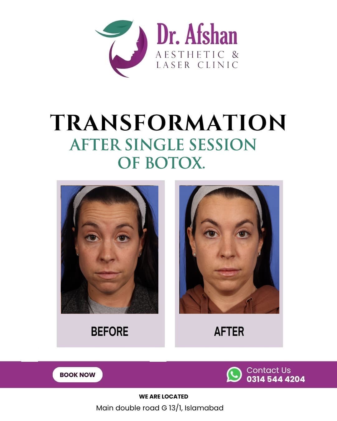 Botulinum Toxin (Botox) — result 2