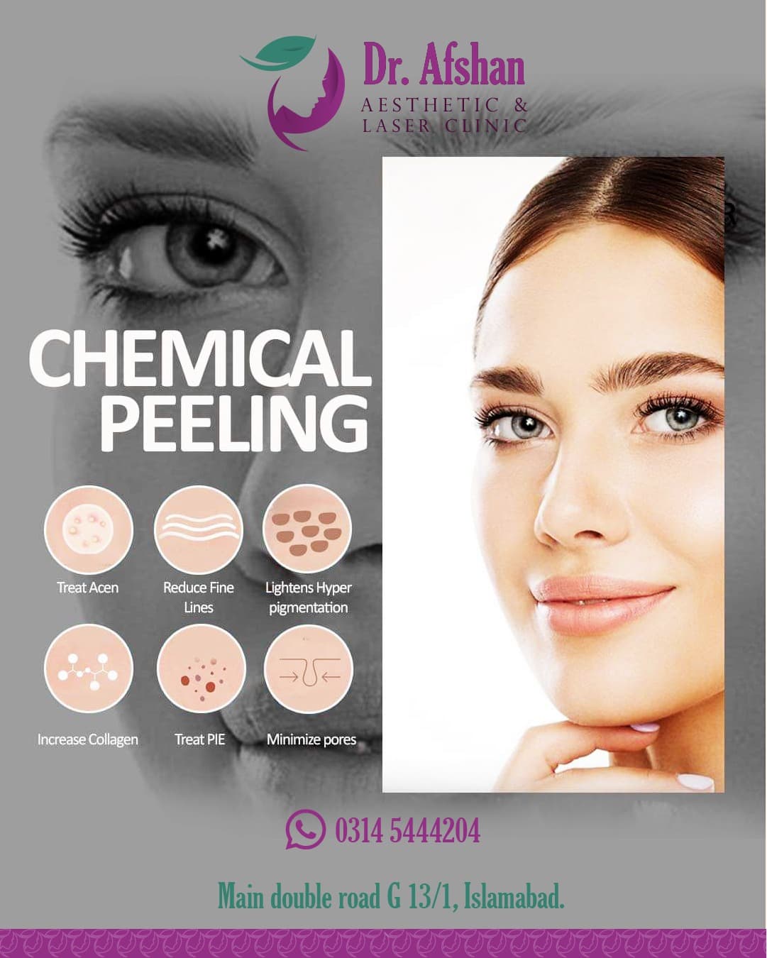 Chemical Peels — result 4