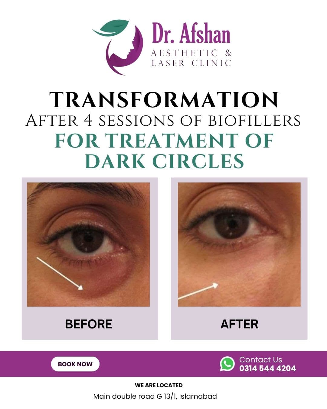 Dark Circle Treatment — result 1