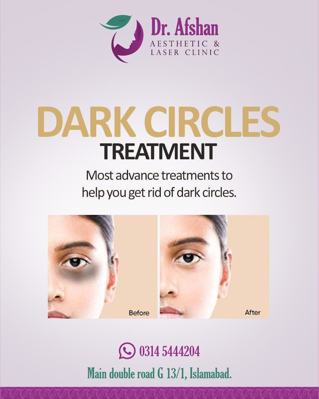 Dark Circle Treatment — result 5