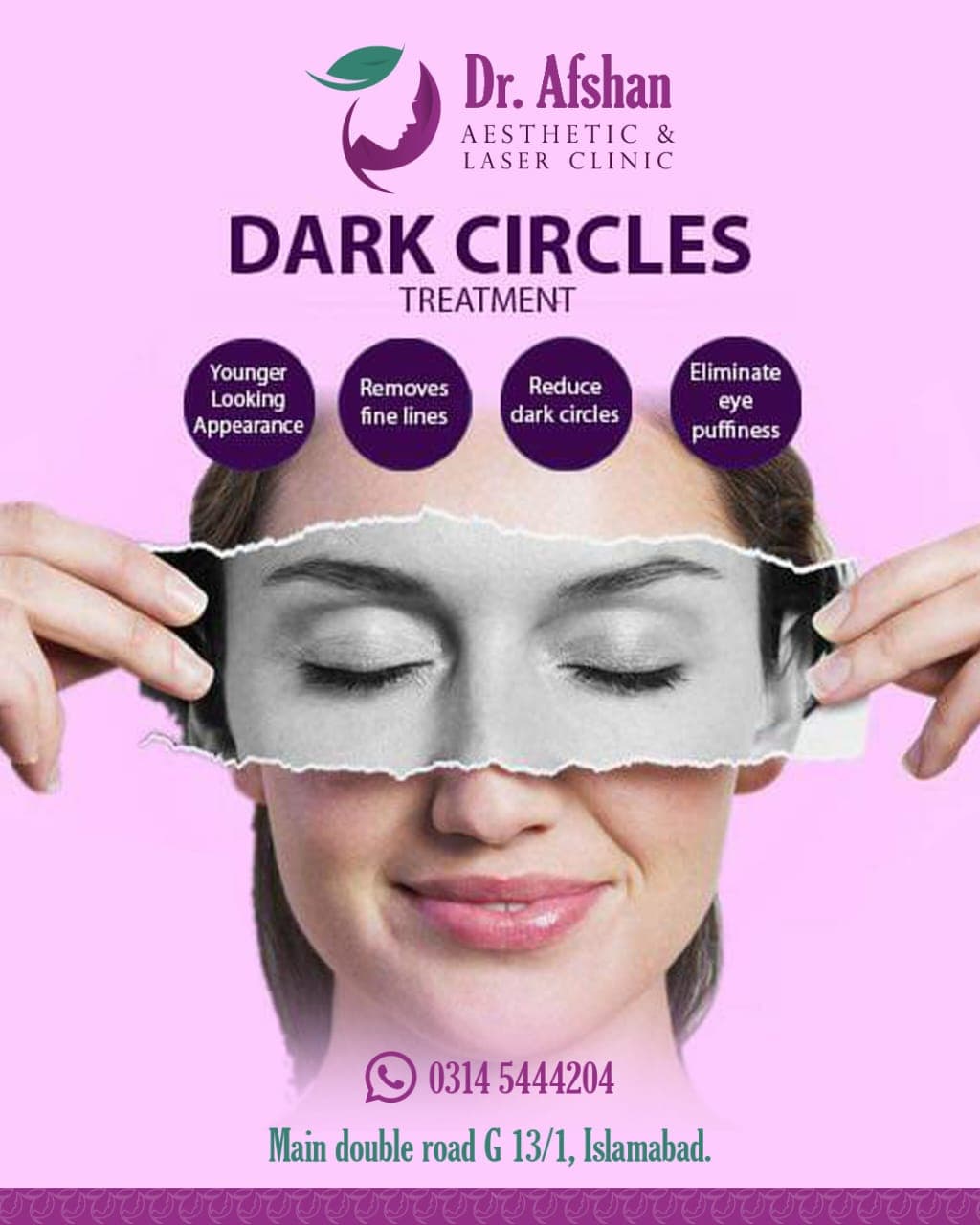 Dark Circle Treatment — result 6