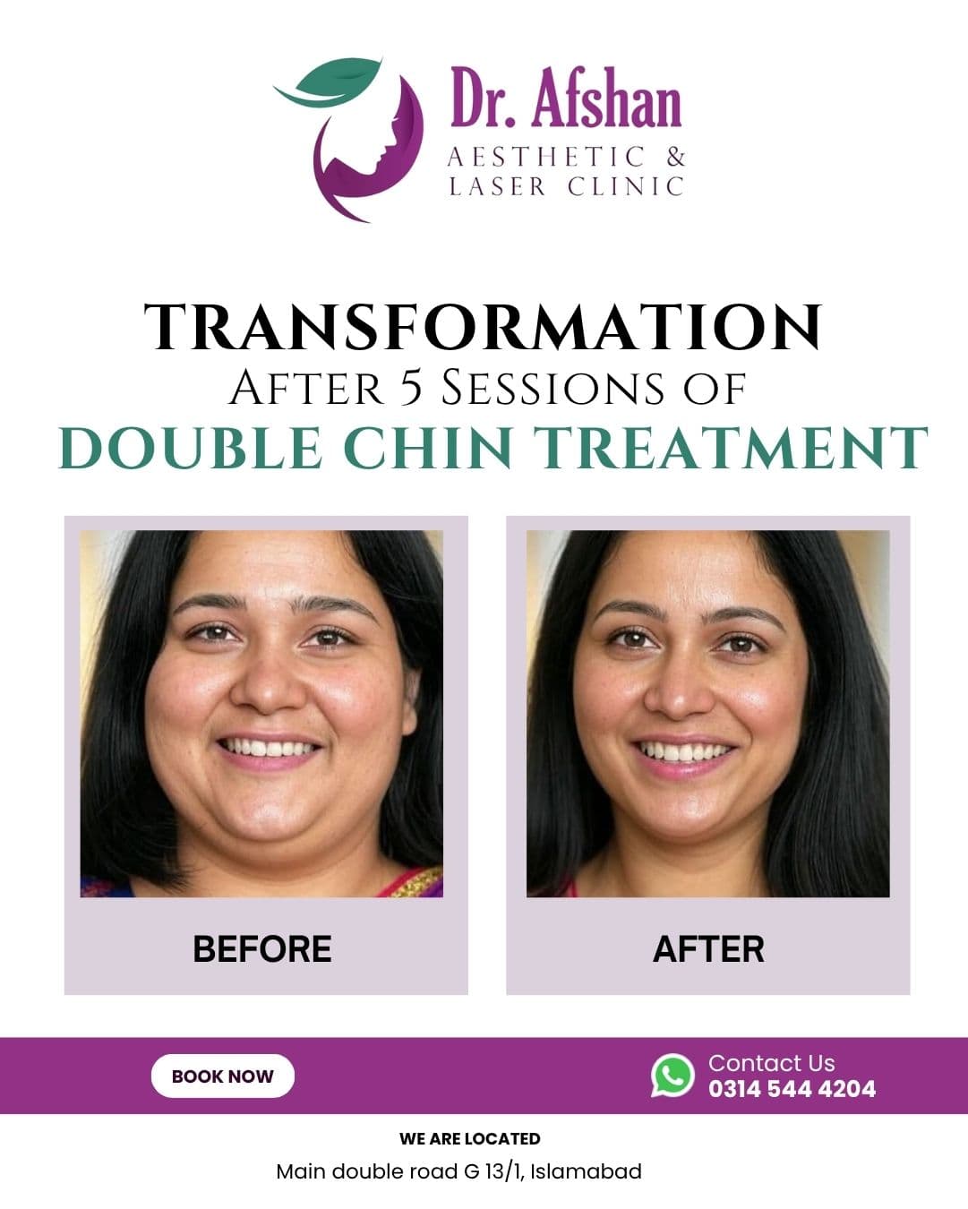 Fat Dissolving Injections — result 1