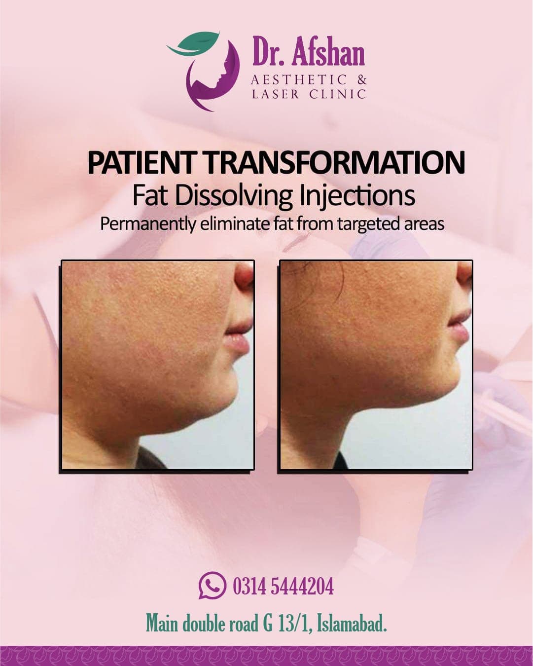 Fat Dissolving Injections