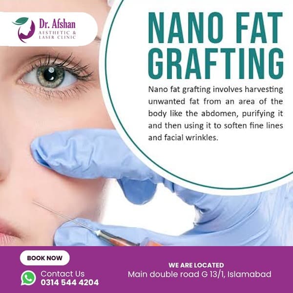 Fat Grafting — result 2