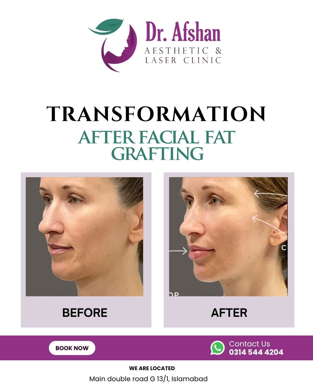 Fat Grafting — result 5
