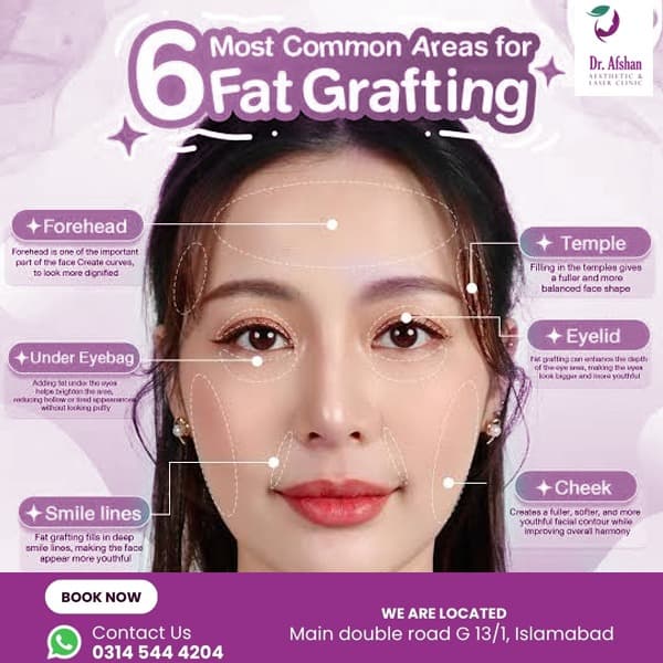 Fat Grafting — result 7