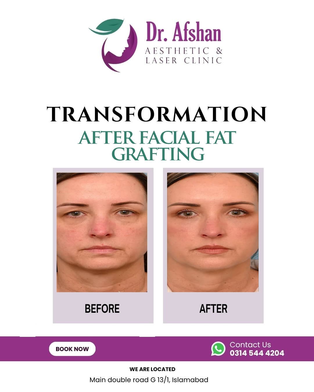 Fat Grafting — result 8
