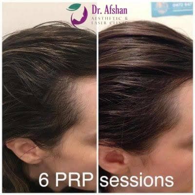 Hair Restoration — result 6