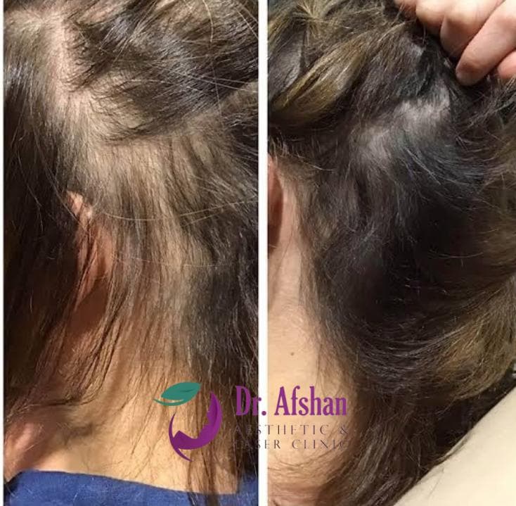 Hair Restoration — result 7