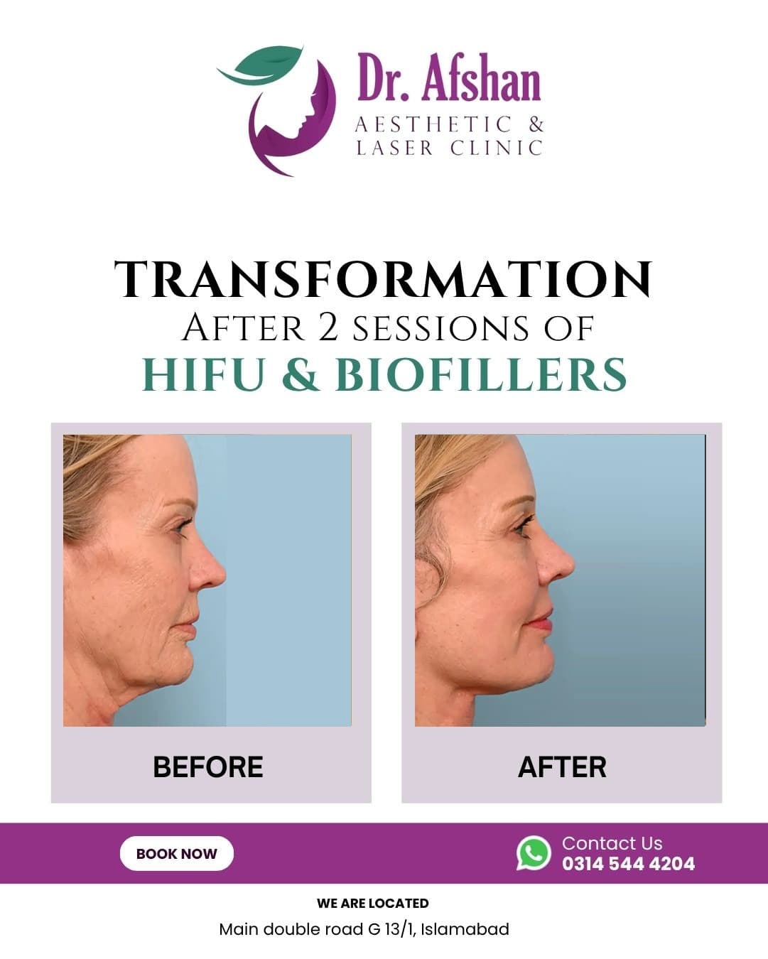 HIFU Face Lift — result 4