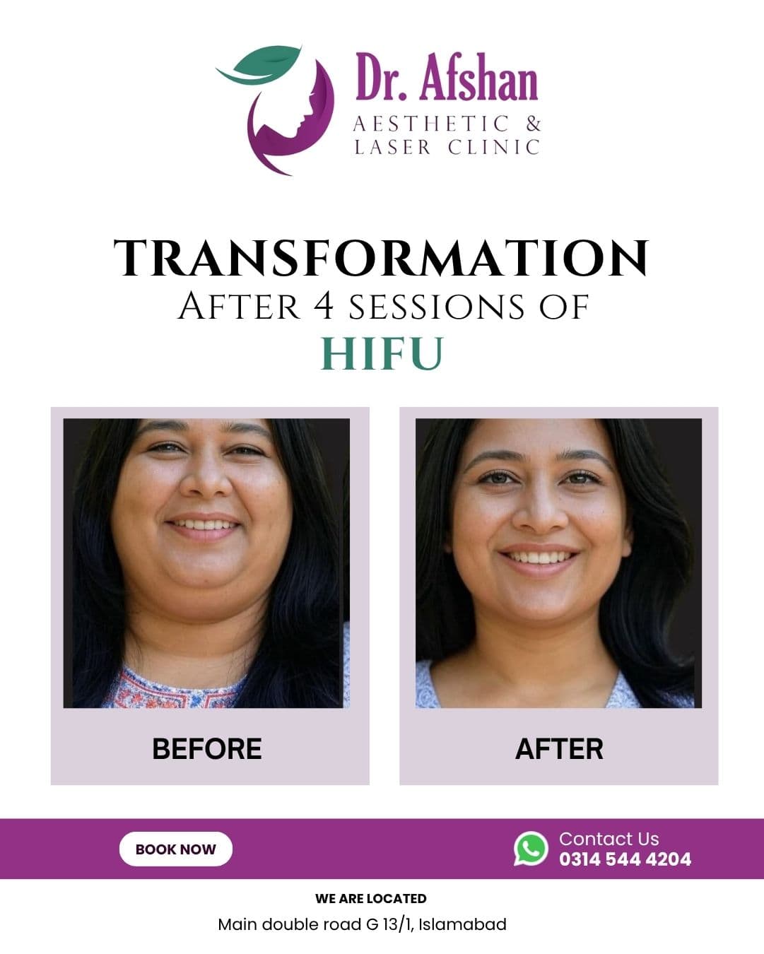 HIFU Face Lift — result 7