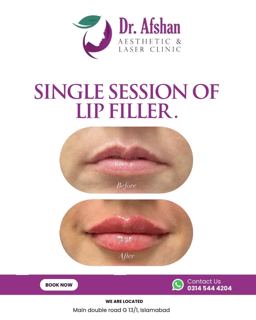 Lip Fillers — result 2