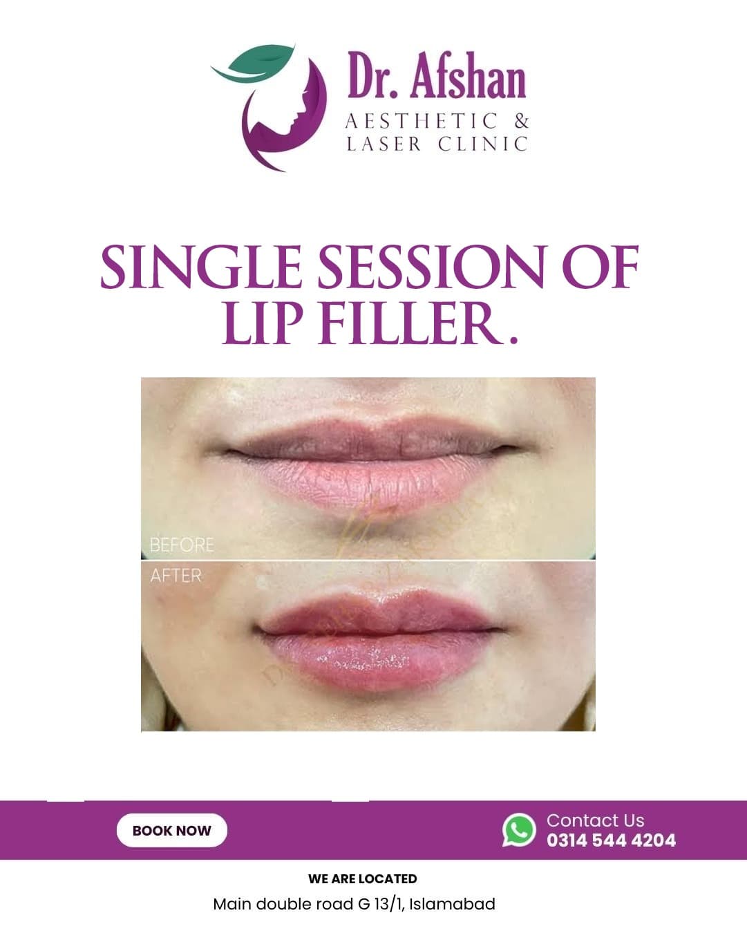 Lip Fillers — result 3