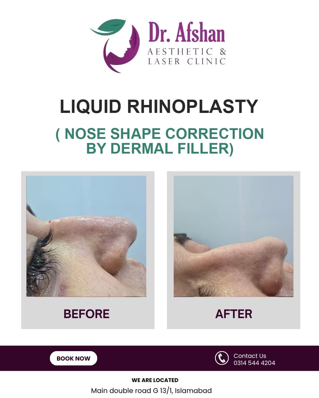 Liquid Rhinoplasty — result 1
