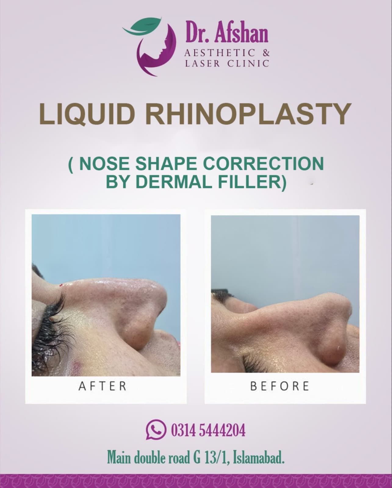 Liquid Rhinoplasty — result 3