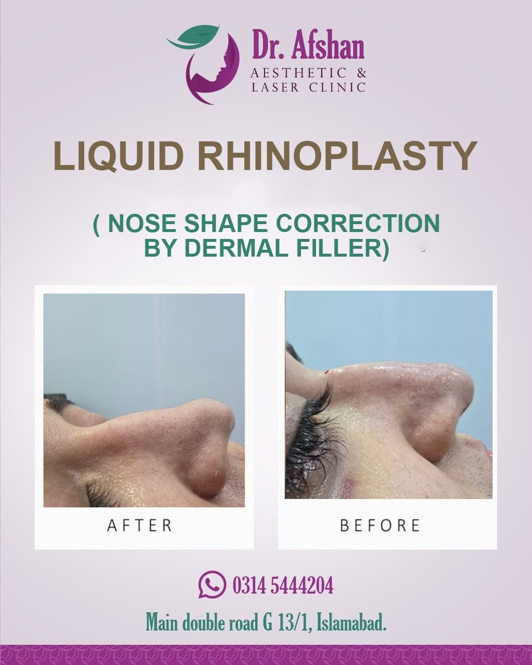 Liquid Rhinoplasty — result 5