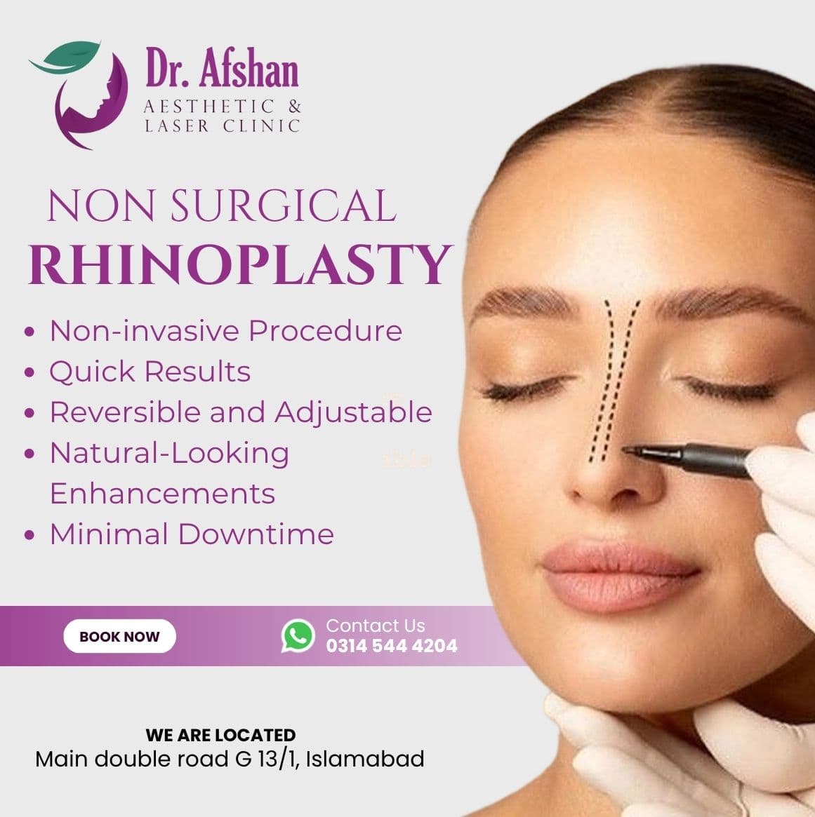 Liquid Rhinoplasty — result 6