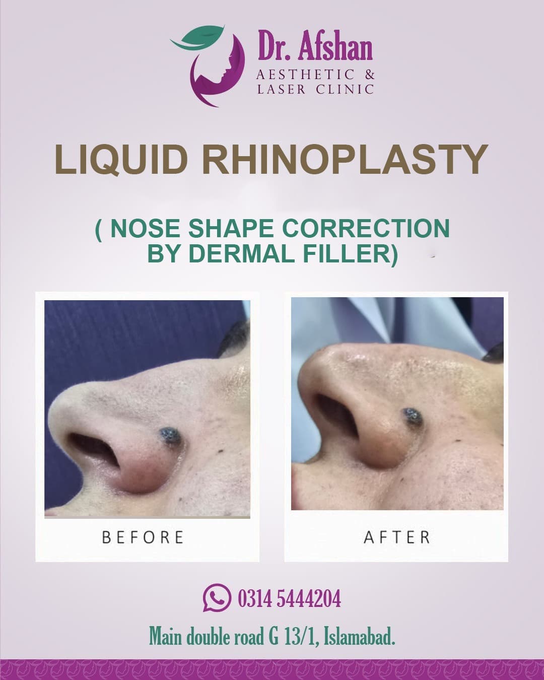 Liquid Rhinoplasty — result 7