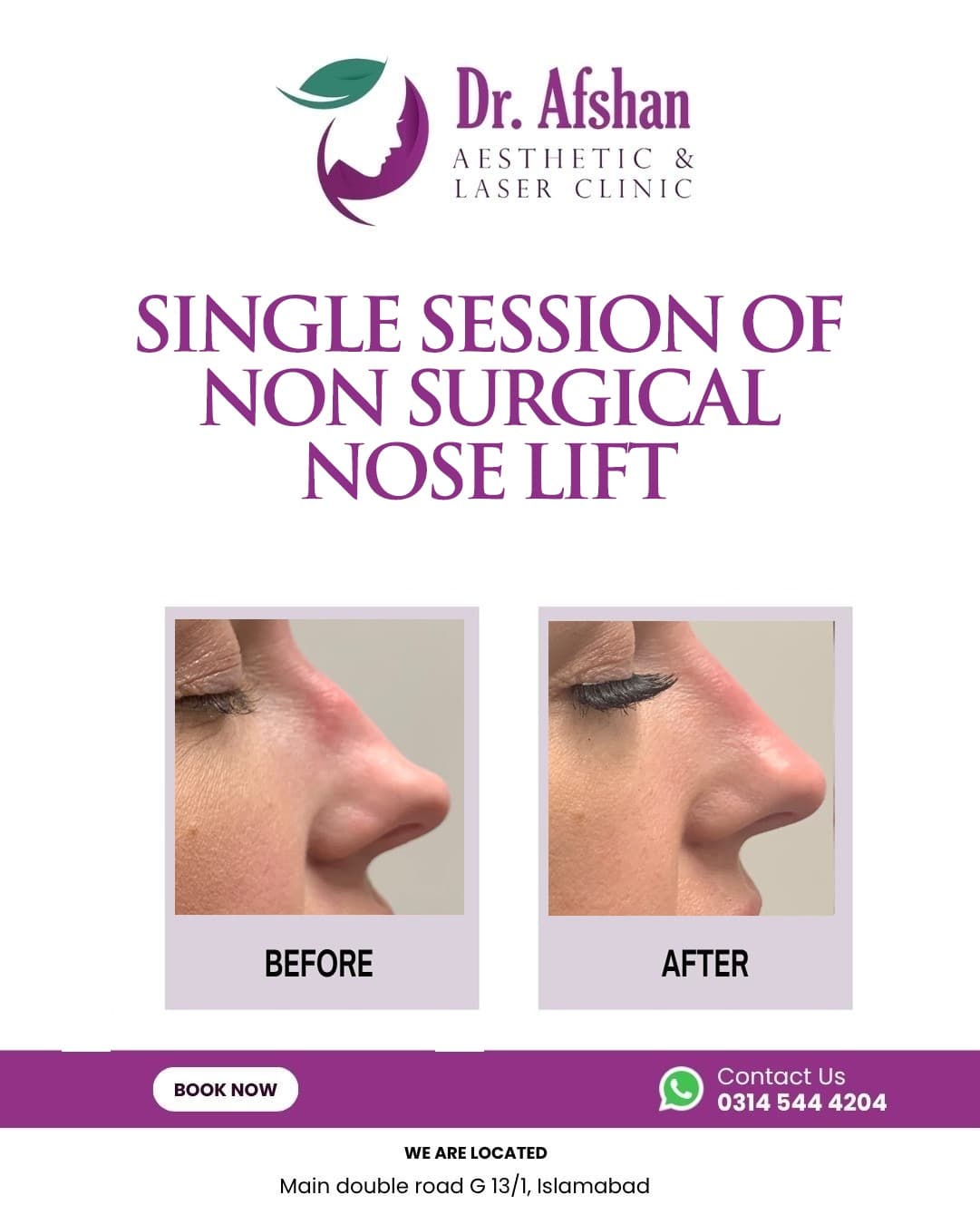 Liquid Rhinoplasty — result 8