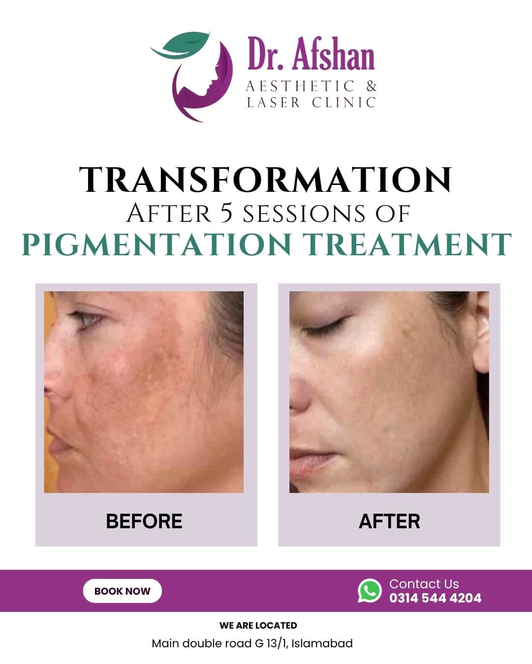 Melasma & Pigmentation
