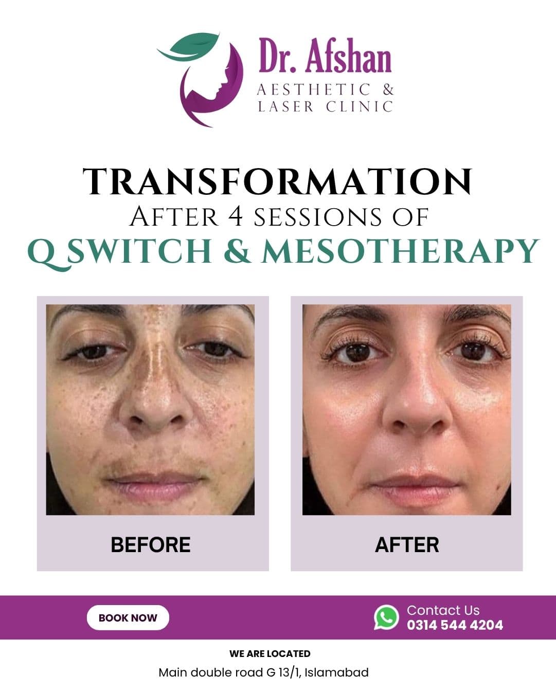 Melasma & Pigmentation — result 2