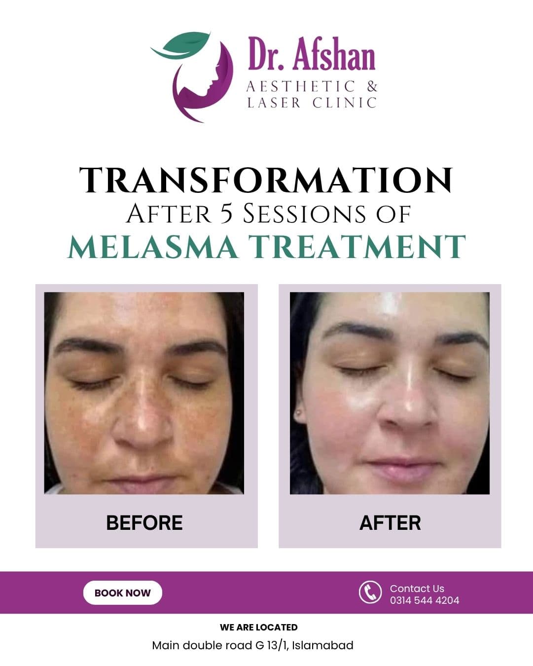 Melasma & Pigmentation — result 3