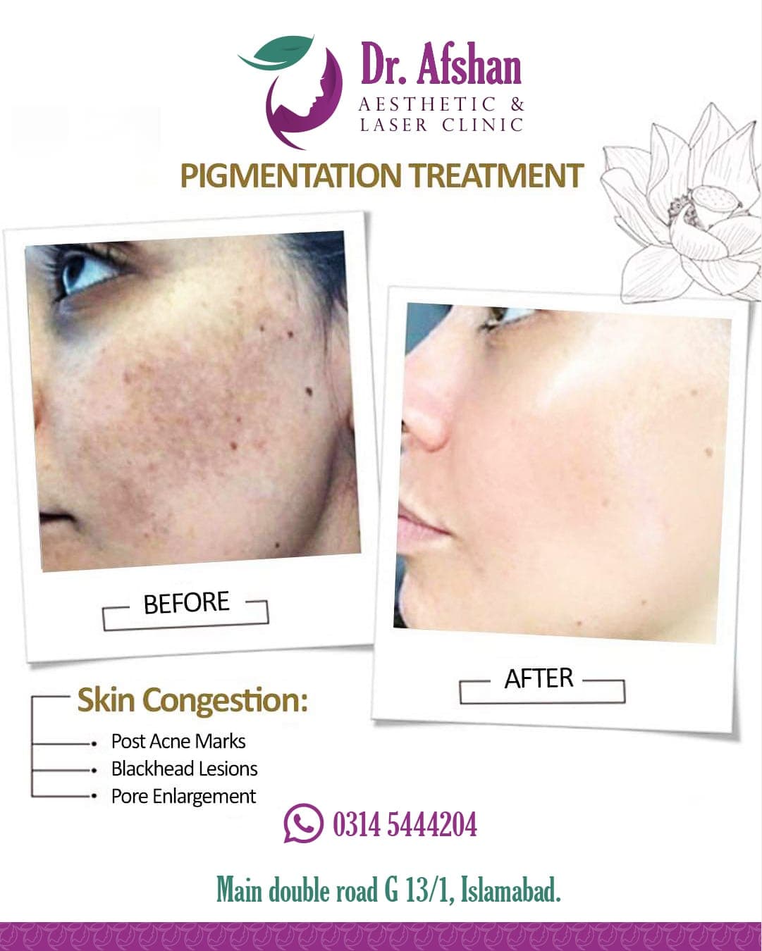 Melasma & Pigmentation — result 4
