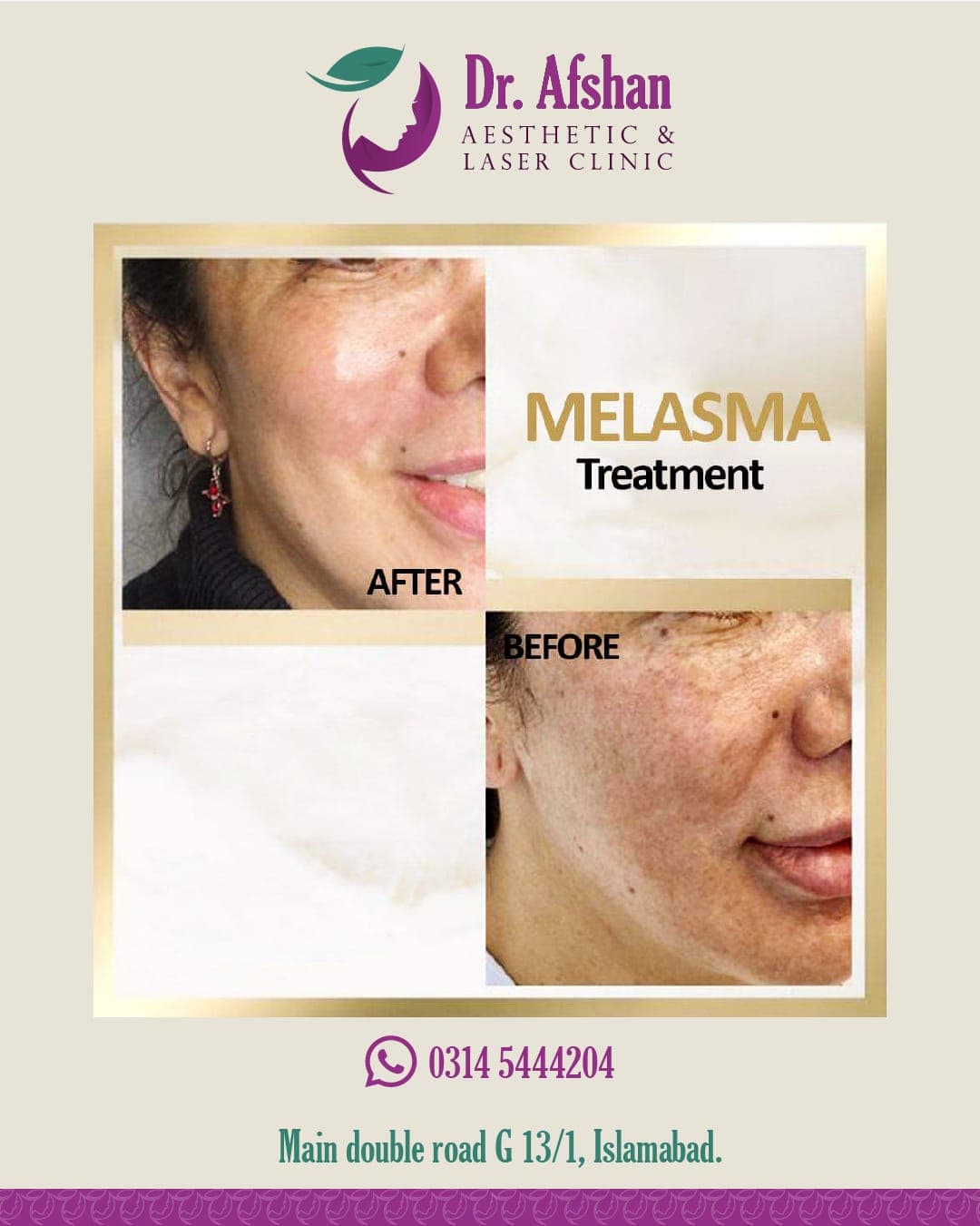 Melasma & Pigmentation — result 6