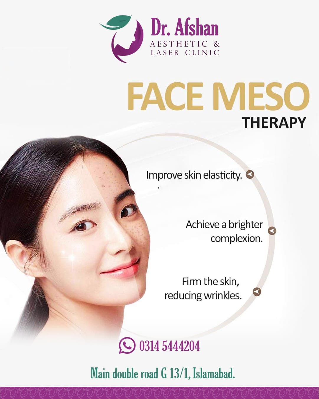 Mesotherapy — result 2