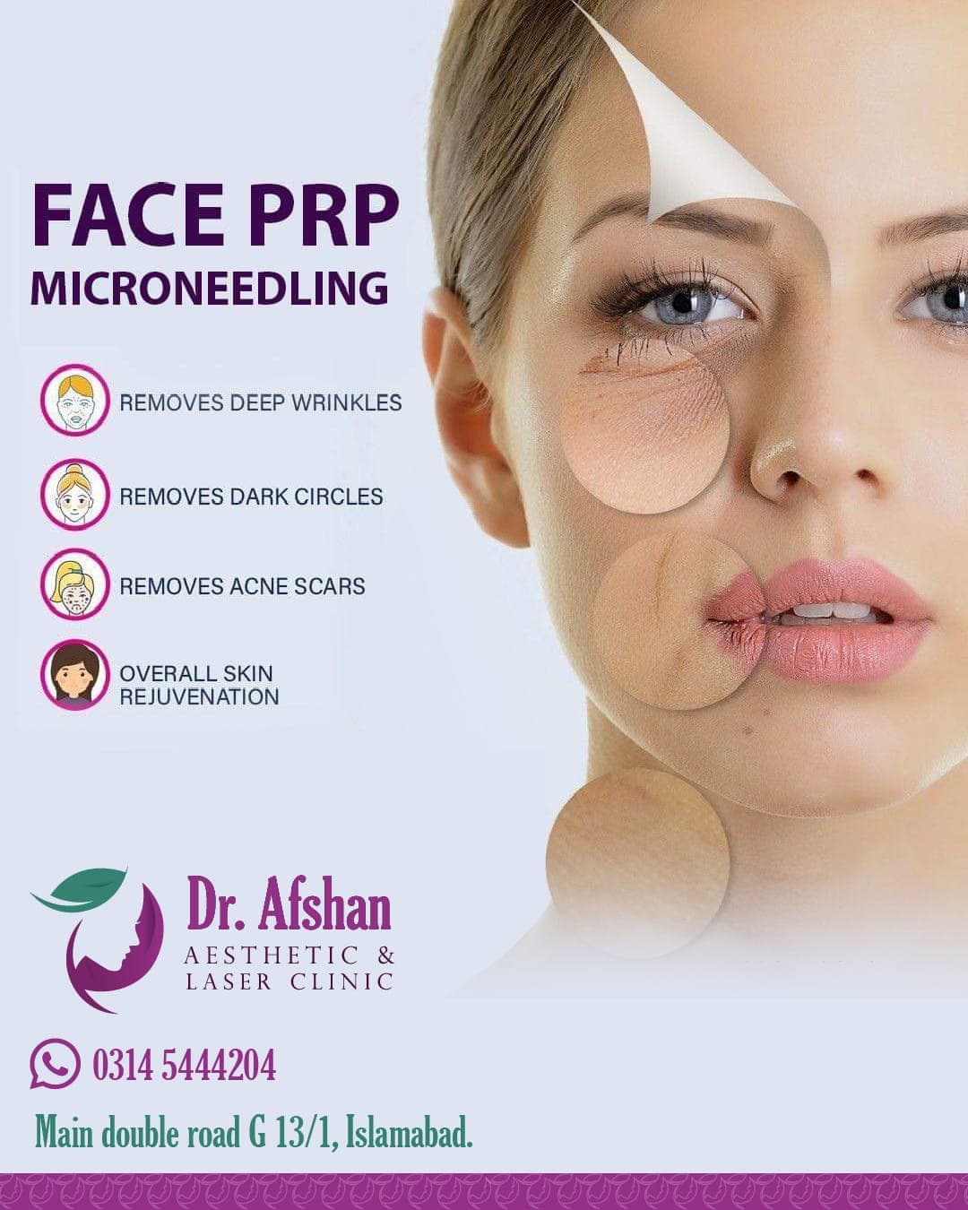 Microneedling