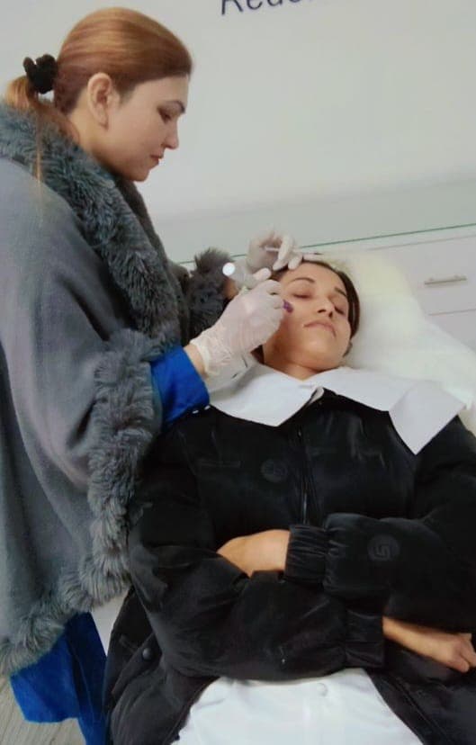 Microneedling — result 2