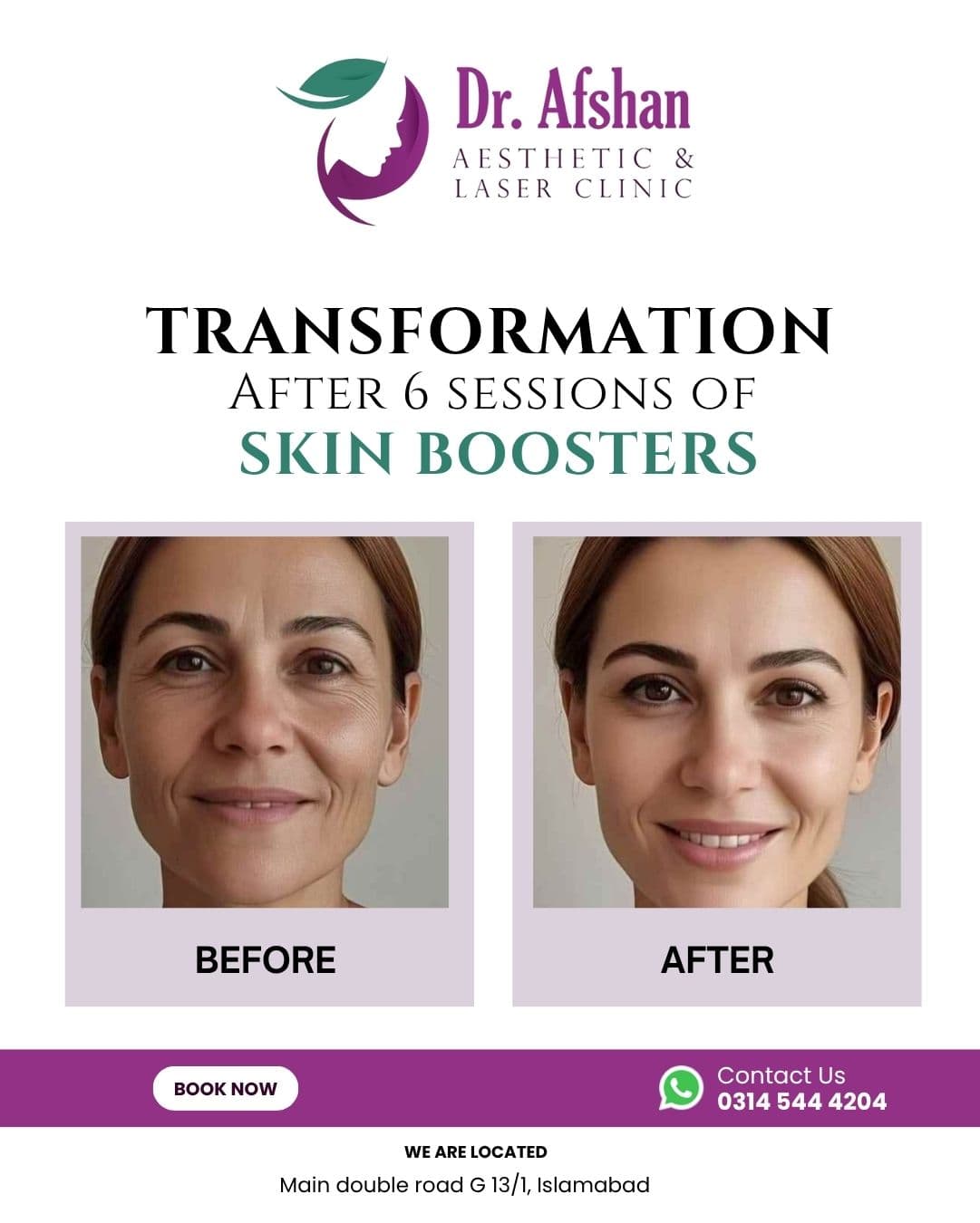 Skin Boosters & Profhilo — result 1