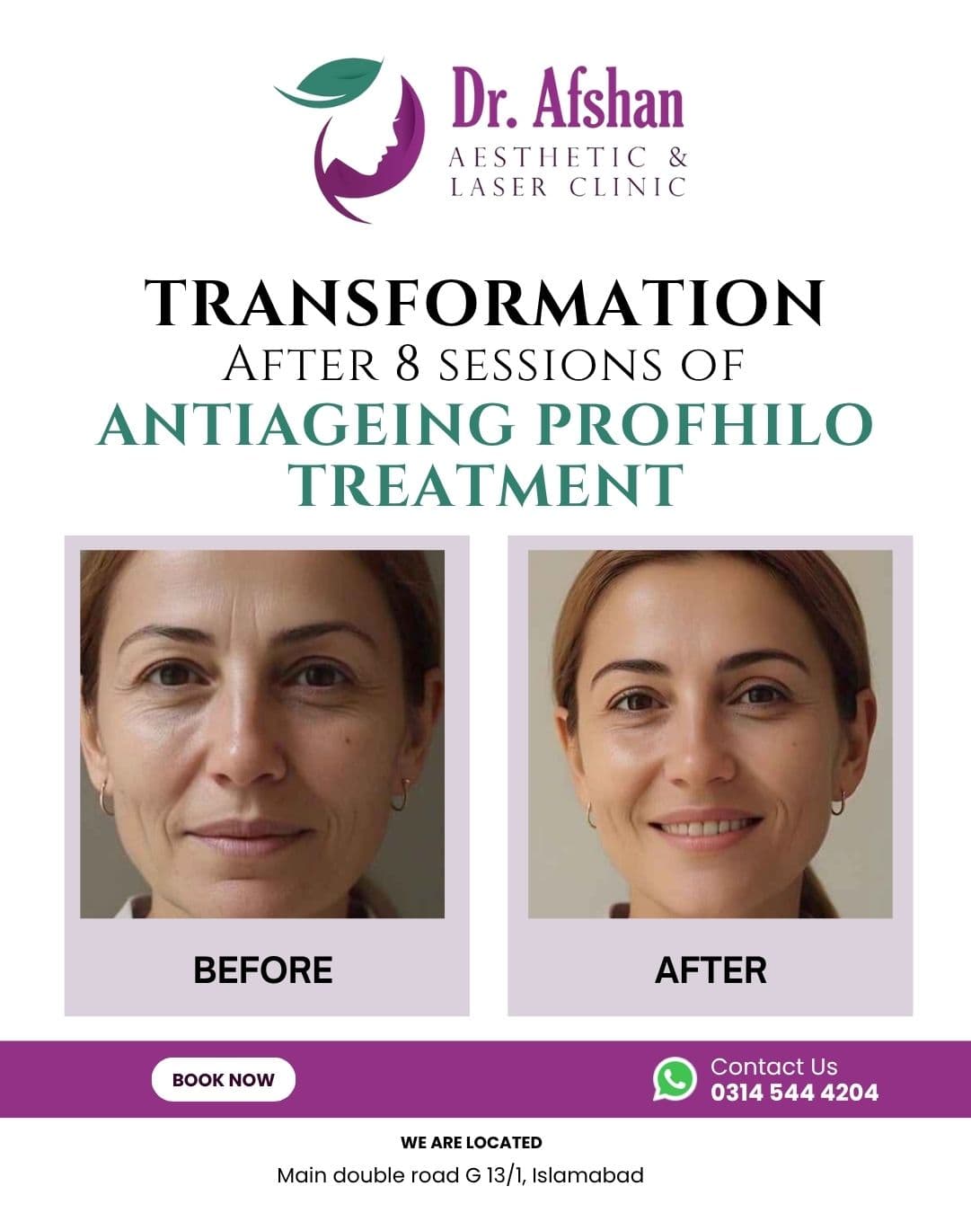 Skin Boosters & Profhilo
