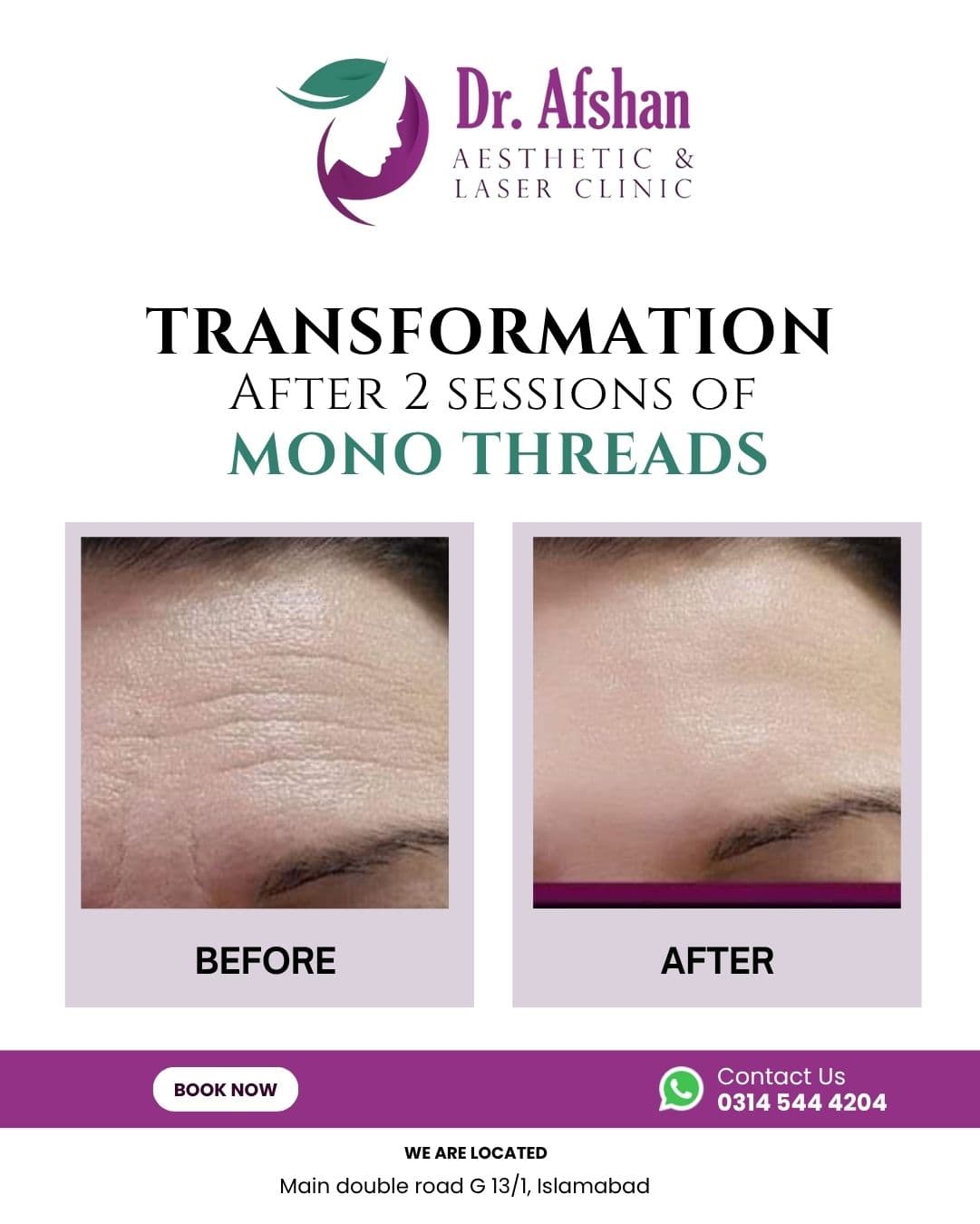 Thread Lift & Monothreads — result 1