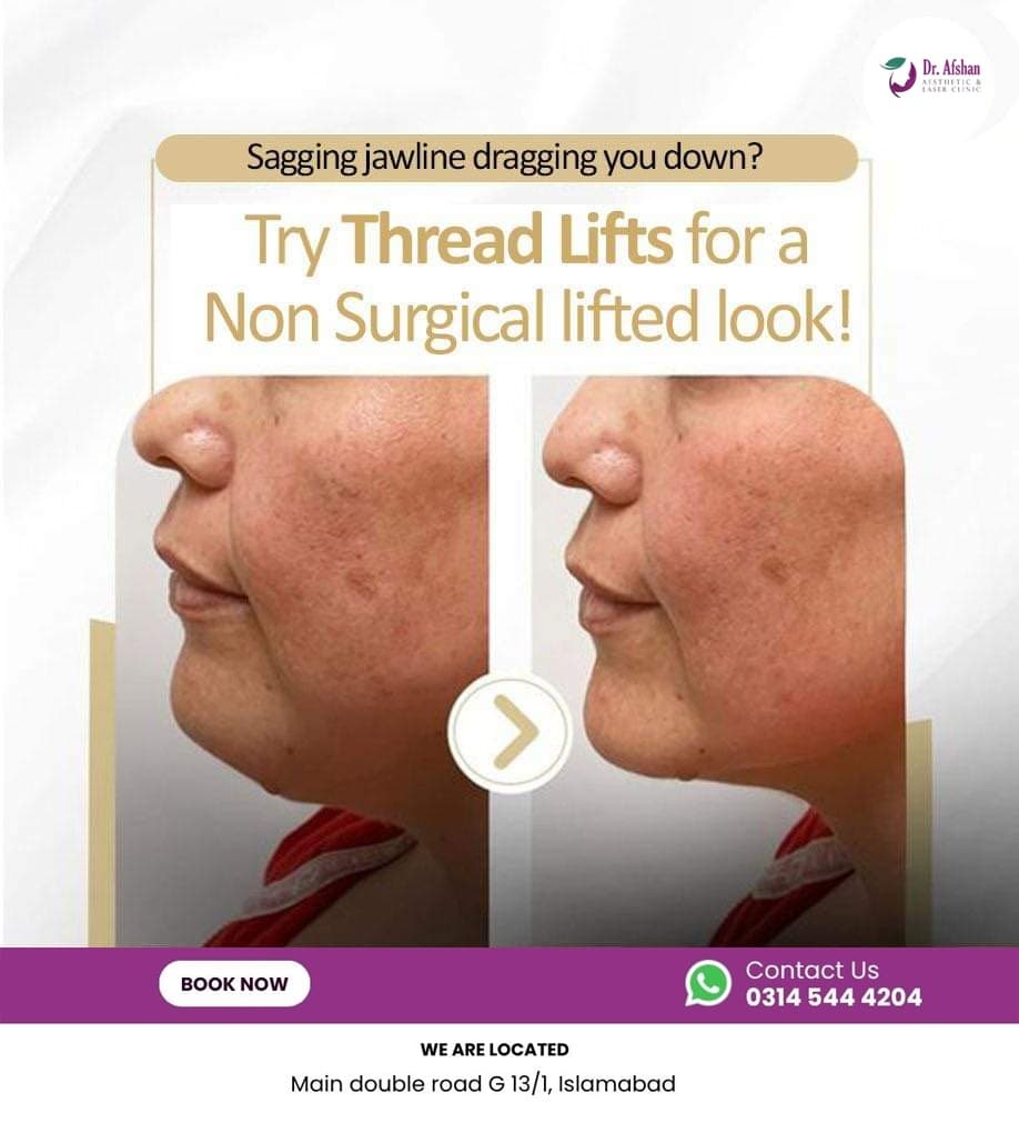 Thread Lift & Monothreads