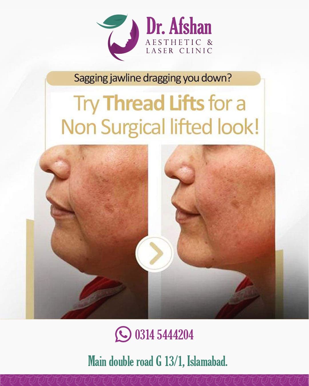 Thread Lift & Monothreads — result 3