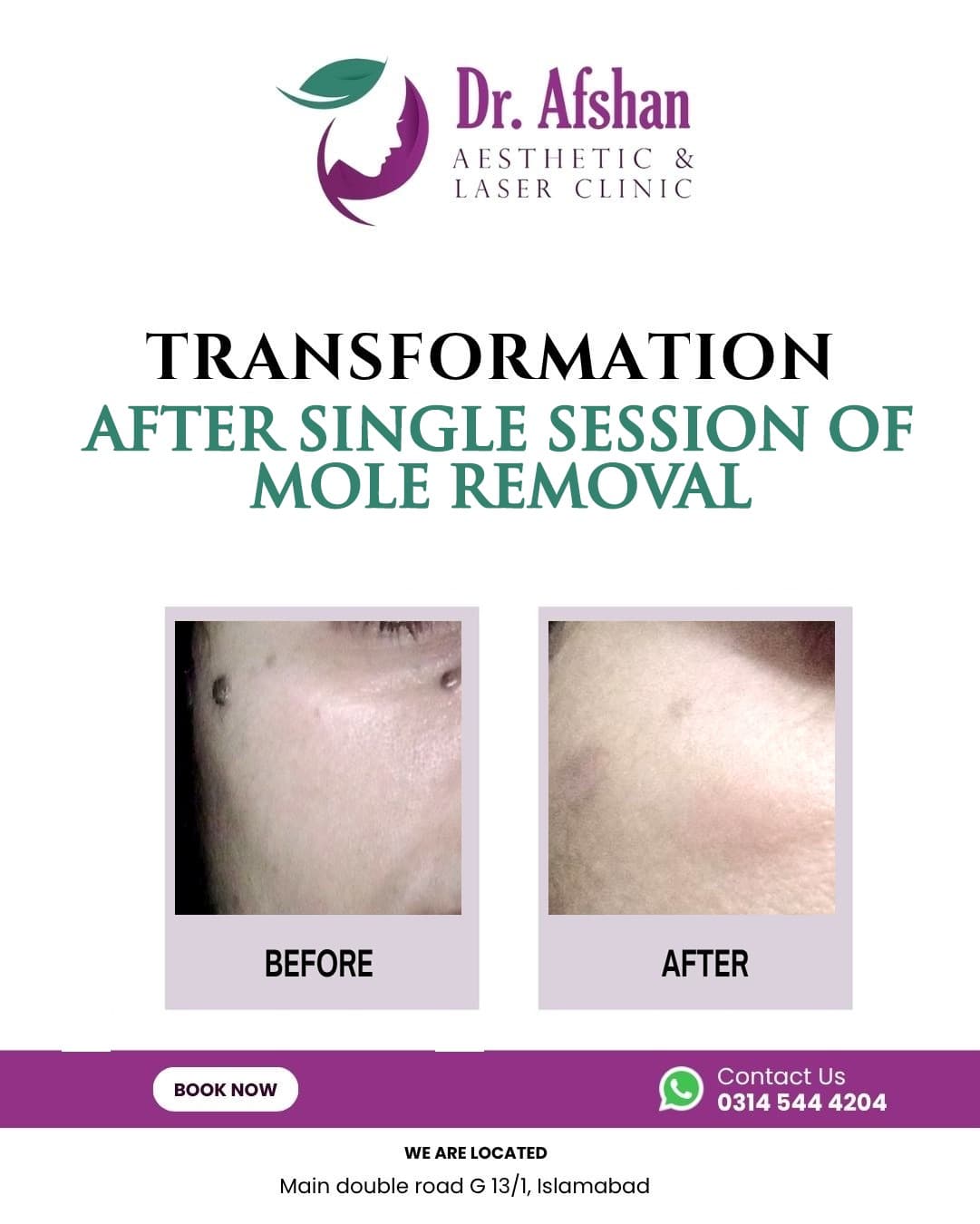 Warts & Moles Removal