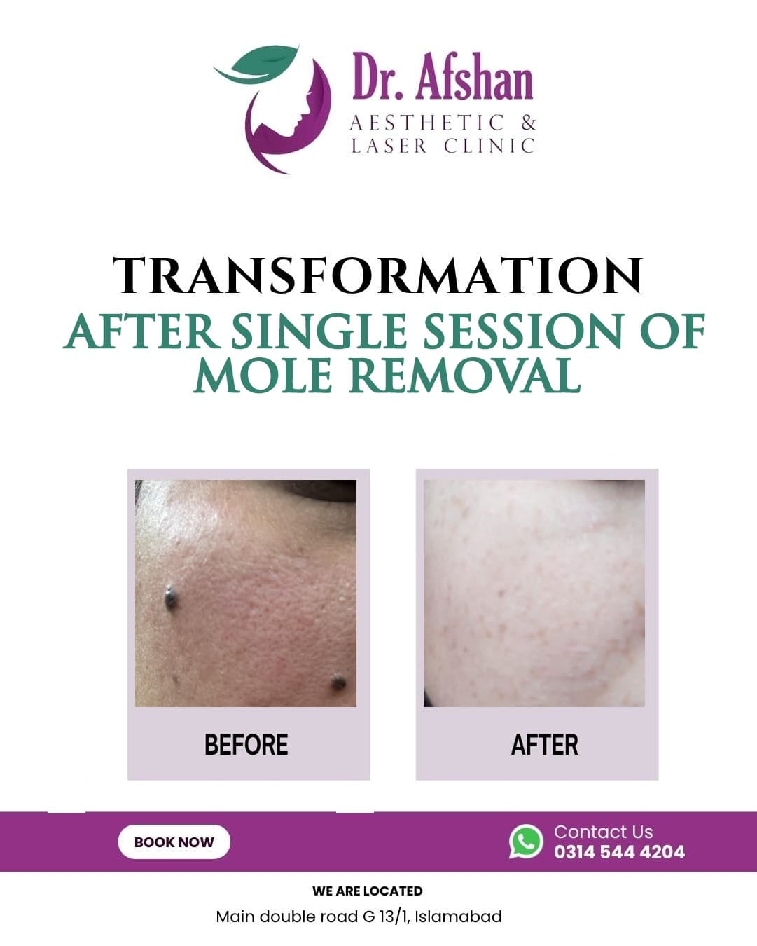 Warts & Moles Removal — result 3